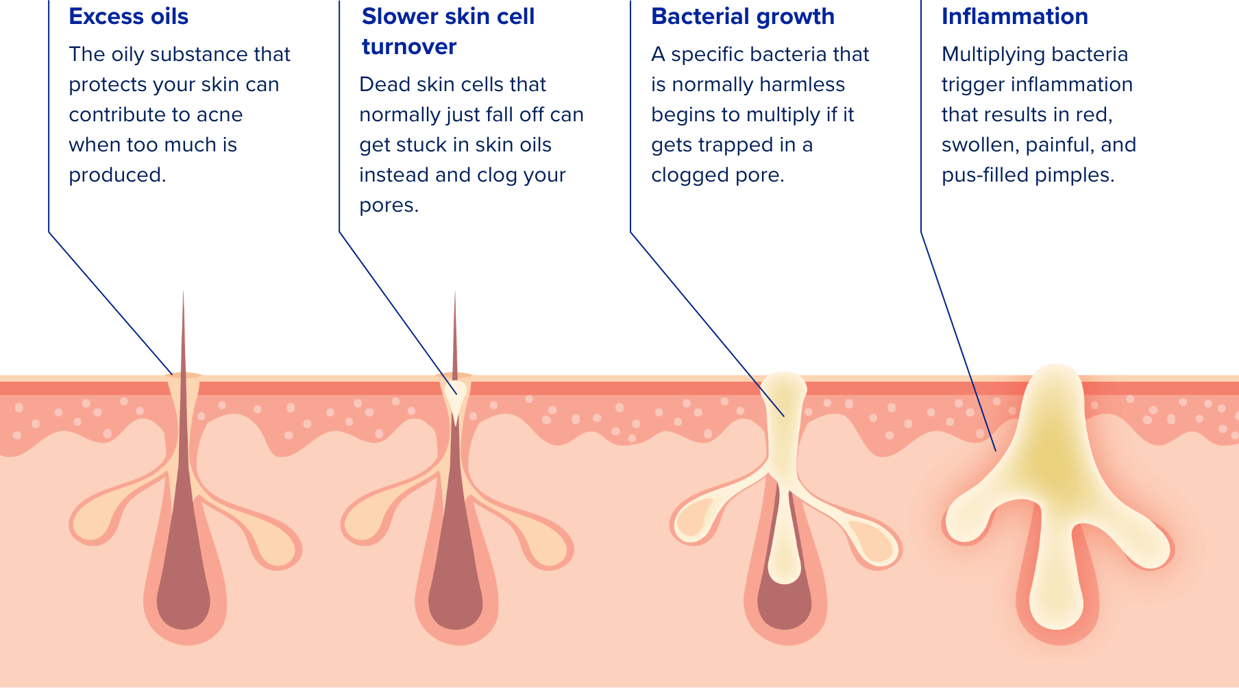 Cross section illustration of skin pores showing the four causes of acne