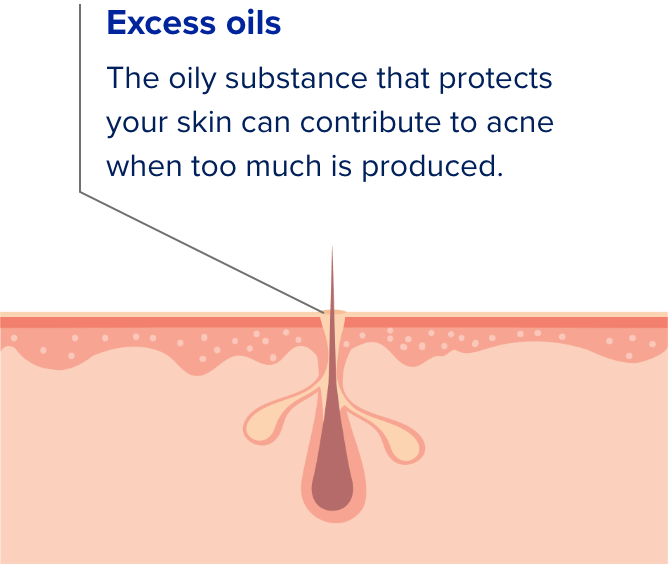 Cross section illustration of skin pores showing the four causes of acne