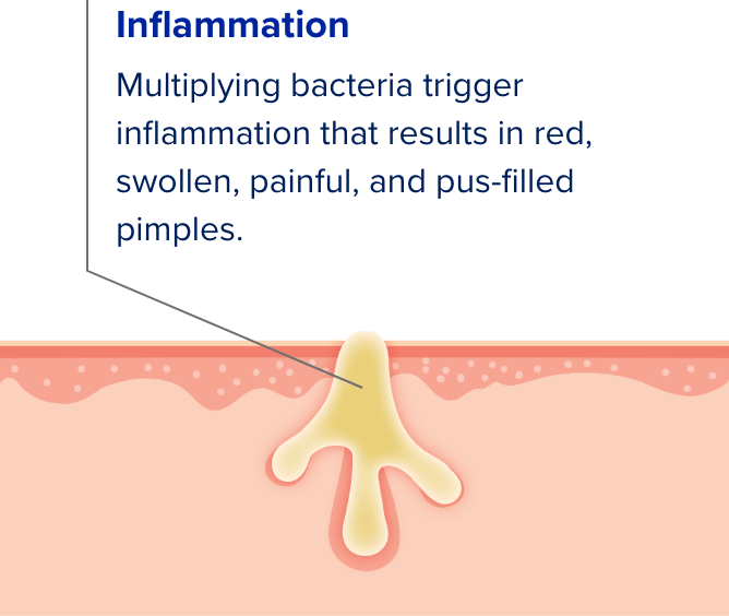 Cross section illustration of skin pores showing the four causes of acne