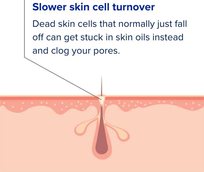 Cross section illustration of skin pores showing the four causes of acne